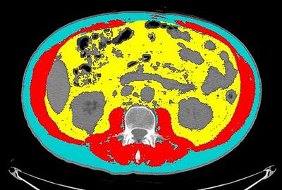 CT-Derived Body Composition Values and Complications After Pneumonectomy in Lung Cancer Patients: Time for a Sex-Related Analysis?